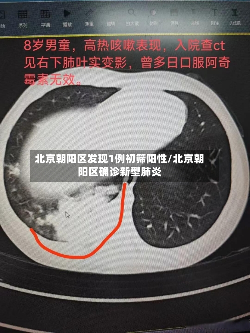 北京朝阳区发现1例初筛阳性/北京朝阳区确诊新型肺炎-第1张图片