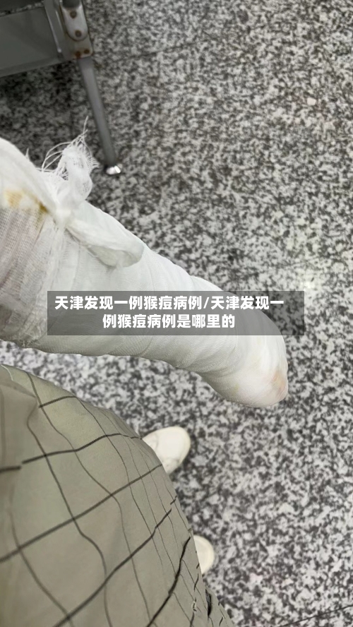 天津发现一例猴痘病例/天津发现一例猴痘病例是哪里的-第2张图片