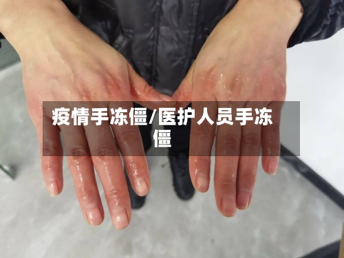 疫情手冻僵/医护人员手冻僵-第2张图片